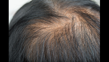 10 Bad Habits That Can Cause Hair Fall