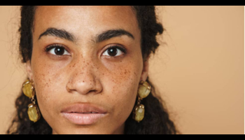 All You Need to Know about PCOS and Hyperpigmentation: Causes and Remedies