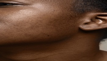 How to Fade Dark Spots in Darker Skin Tones