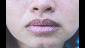 Hyperpigmentation Around Mouth - Causes, Treatment and Prevention