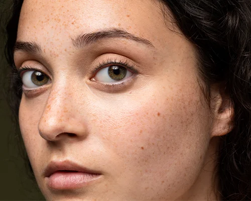 Hyperpigmentation: Debunking common myths and misconceptions