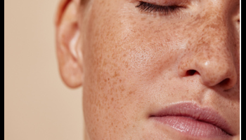 What Is Pigmentation & Different Types Of Pigmentation